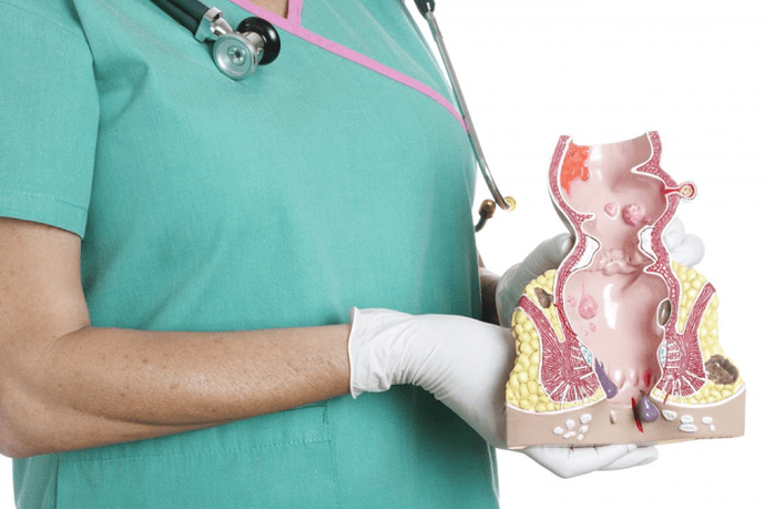 Le médecin démontre le modèle hémorroïde